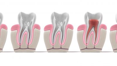Endodonzia e cure canalari