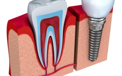 Implantologia dentale